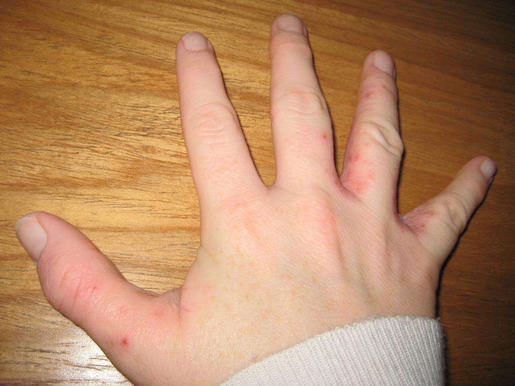 сухая кожа между пальцами рук