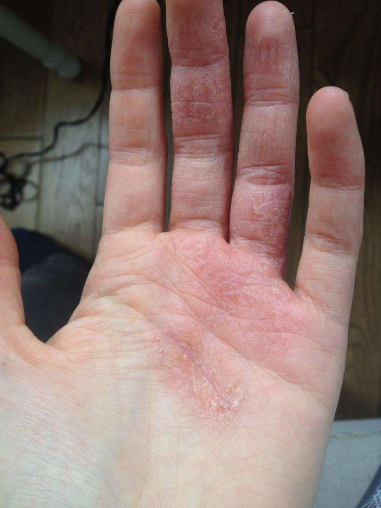 лечение кожи рук